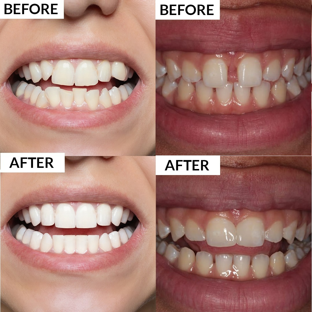 Clear Aligner Result